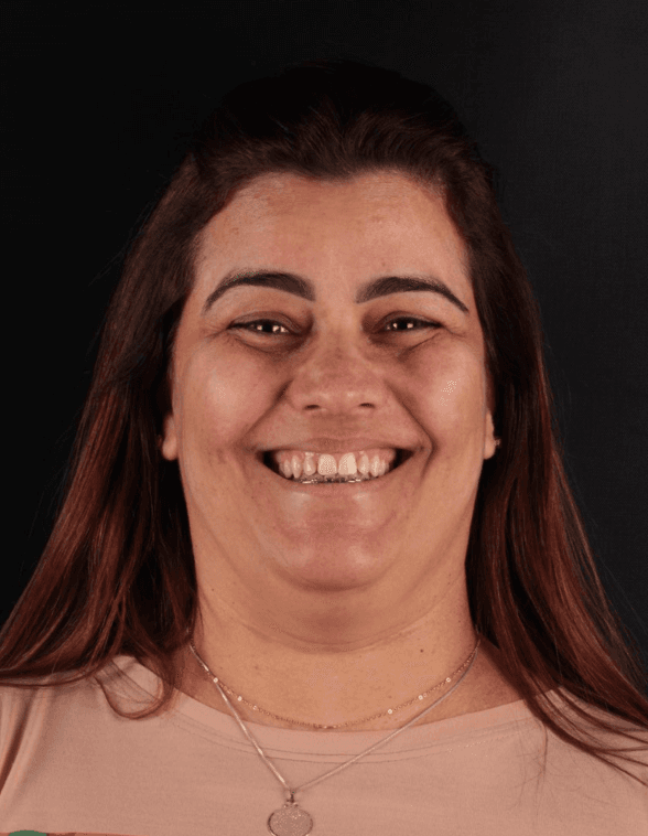 Antes – Paciente 1