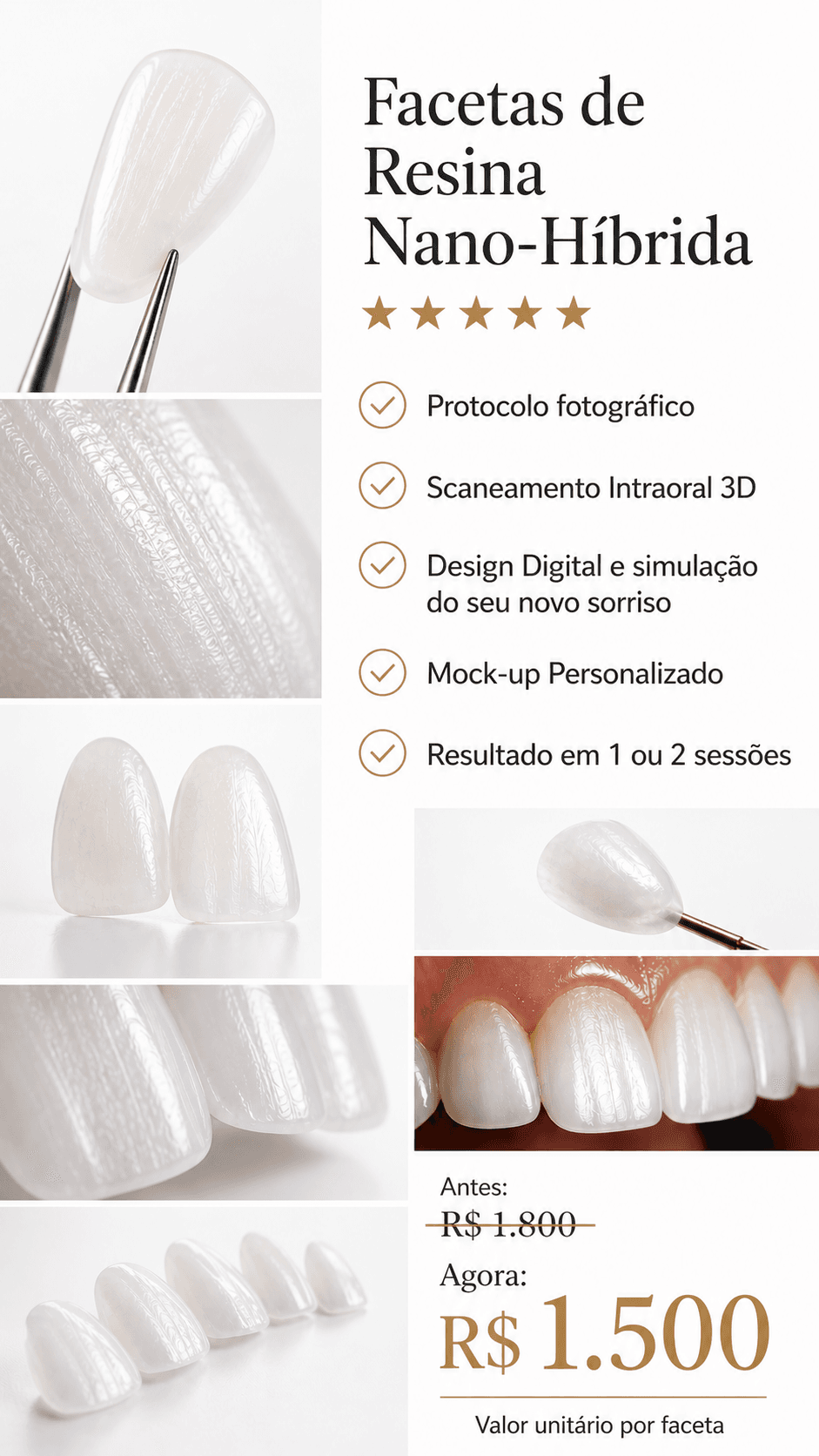 Facetas de Resina Nano-Híbrida — R$ 1.500 valor unitário por faceta